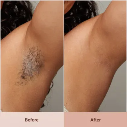 imgi_119_SGVyb181X0JlZm9yZS1BZnRlci1JSV9FcGlsYXRvci0yLnBuZw-w_420